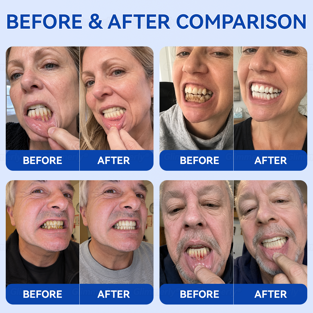 🇮🇪Glimmerly® 🦷GumRevive periodontal repair gel🔥