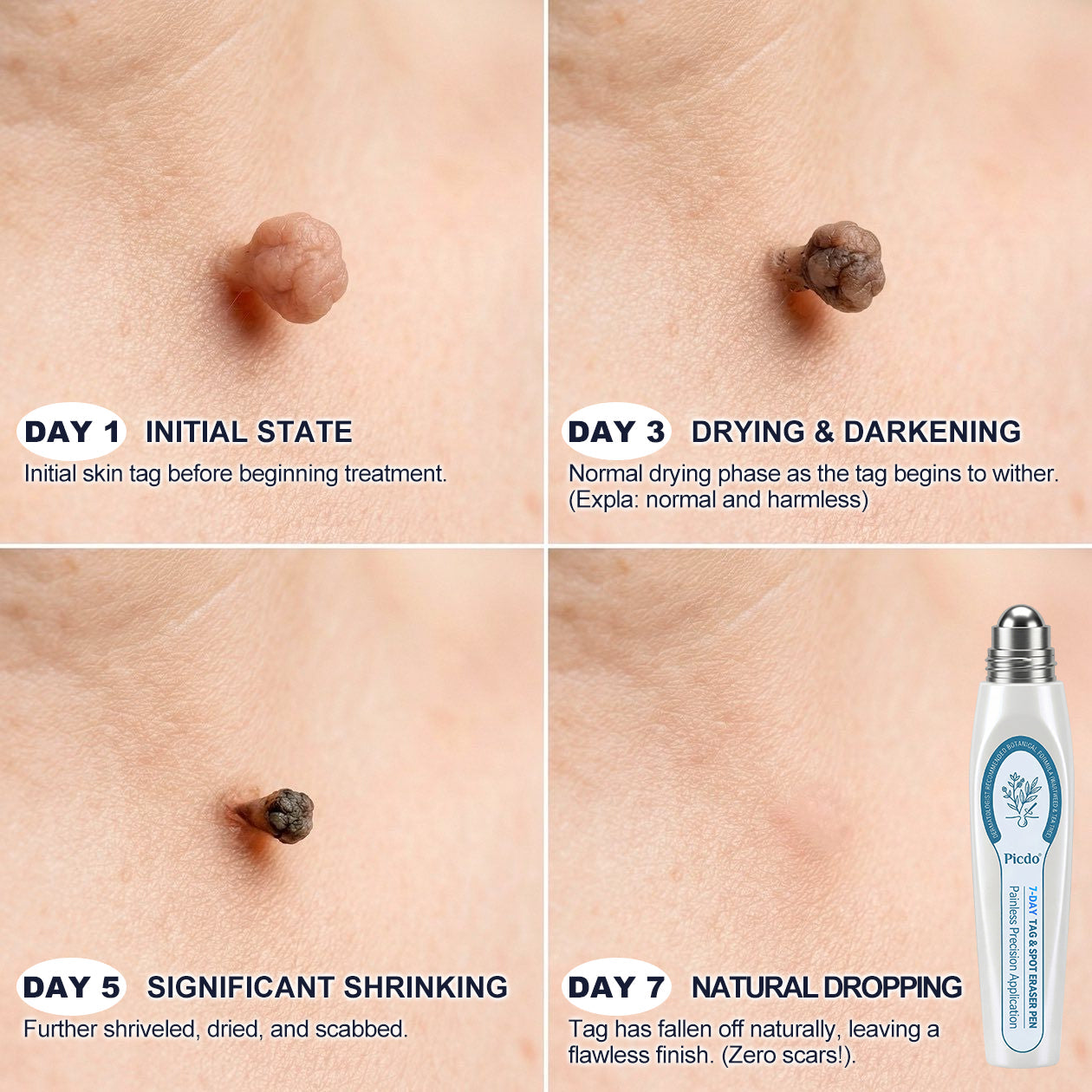 𝐏i𝐜𝐝o® 7-𝐷𝑎𝑦 𝗧𝐚𝐠 & 𝗦𝗽𝐨𝐭 𝐄𝐫𝒂𝒔𝒆𝒓(Zero Pain, Zero 𝐒𝐜𝐚𝒓𝒔 Rollerball) 🎤