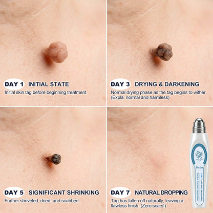 𝐏i𝐜𝐝o® 7-𝐷𝑎𝑦 𝗧𝐚𝐠 & 𝗦𝗽𝐨𝐭 𝐄𝐫𝒂𝒔𝒆𝒓(Zero Pain, Zero 𝐒𝐜𝐚𝒓𝒔 Rollerball) 🎤