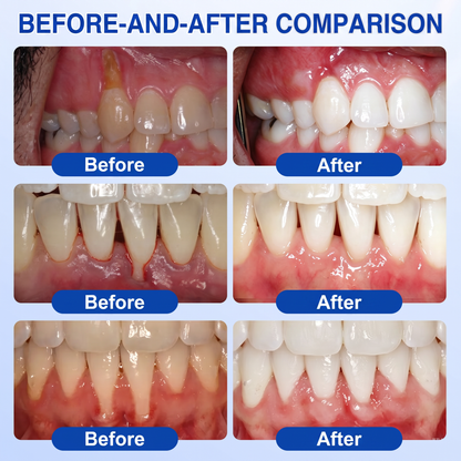 🇮🇪Glimmerly® 🎺GumRevive periodontal repair gel